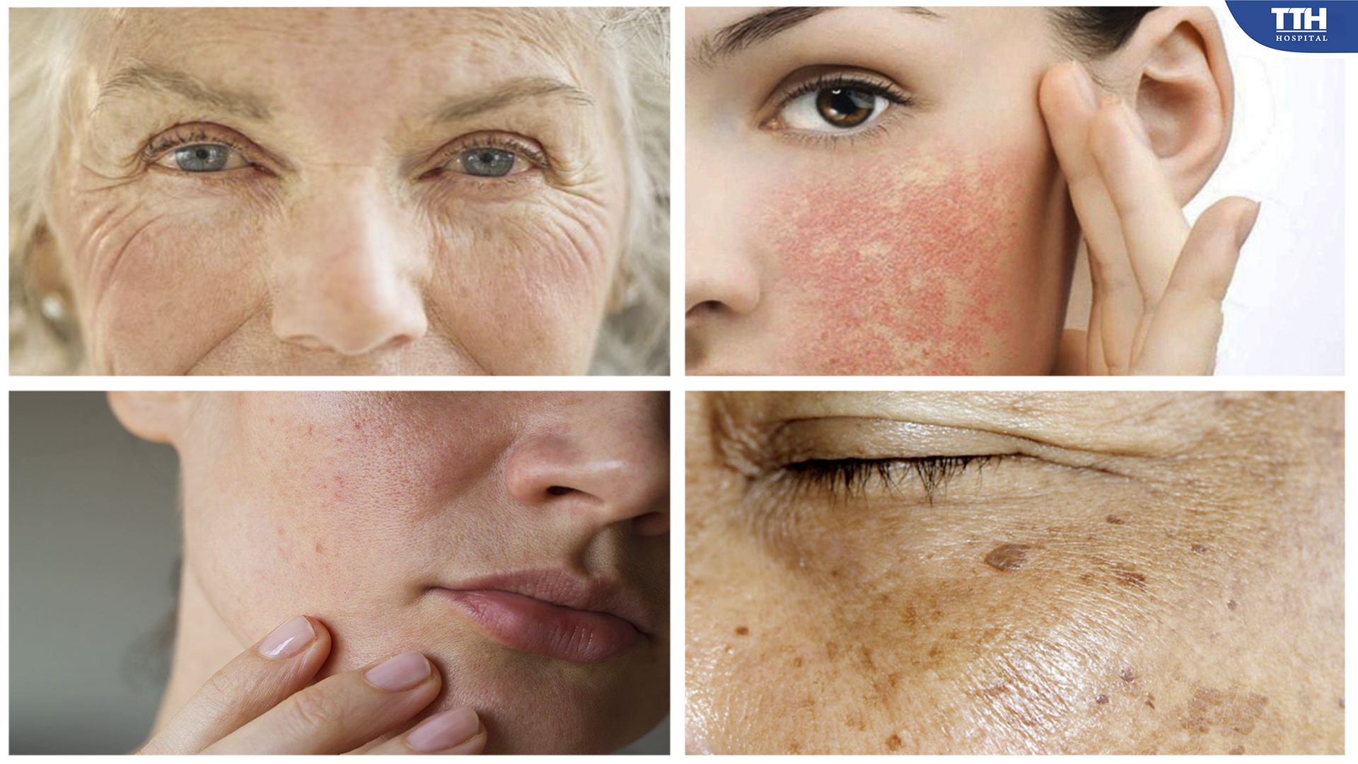 Da nhăn là 1 trong số các biểu hiện của lão hóa