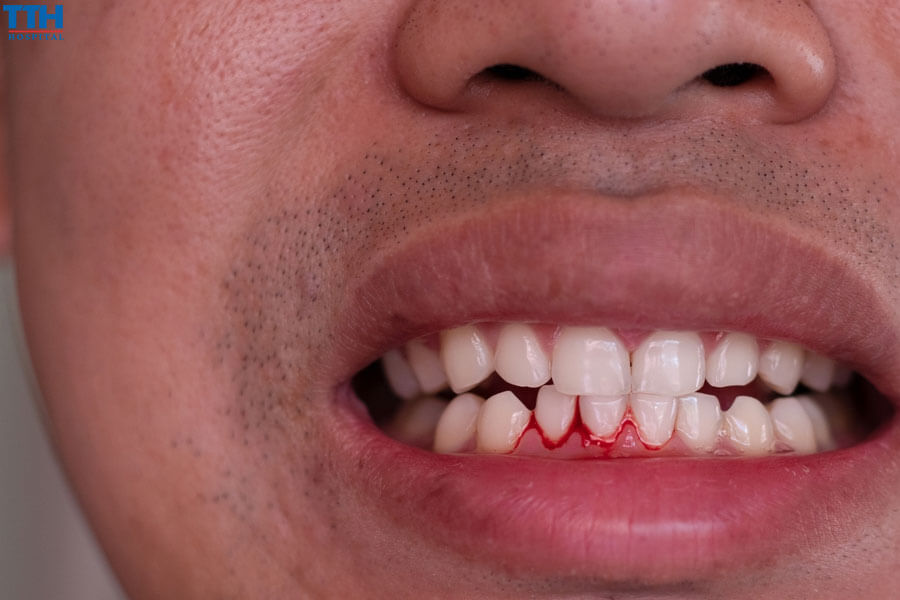 Dấu hiệu nhận biết răng implant bị lung lay