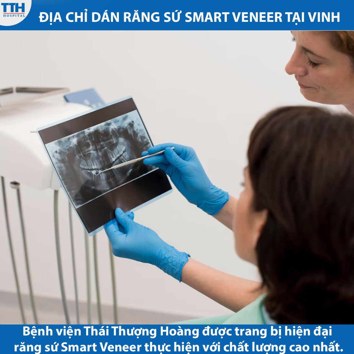 Địa chỉ dán răng sứ Smart Veneer tại Vinh