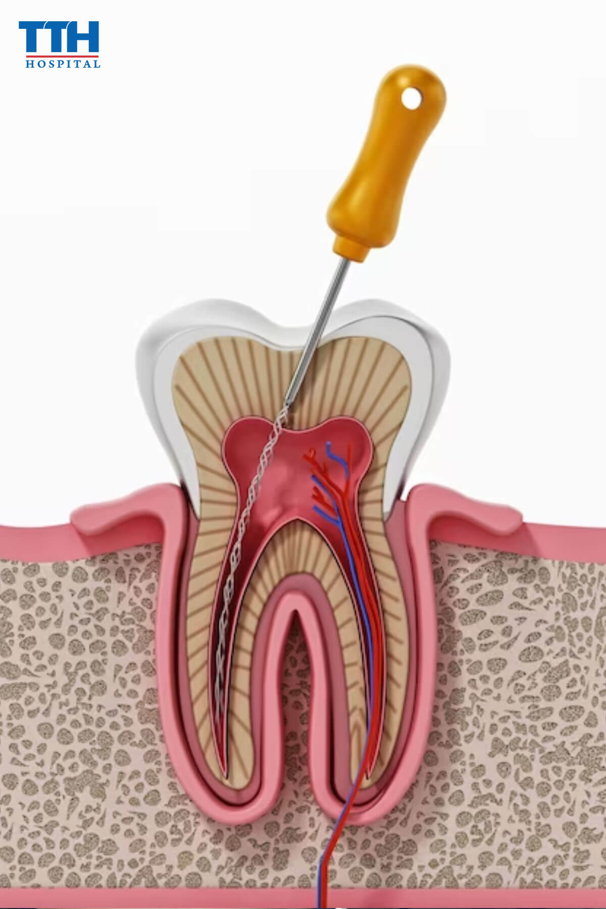 Điều trị sâu răng, viêm tủy răng không triệt để khiến răng sứ ê buốt khi uống lạnh