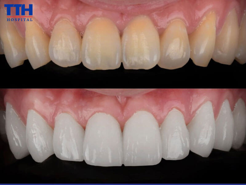 Đối tượng phù hợp nên dán răng sứ Veneer?