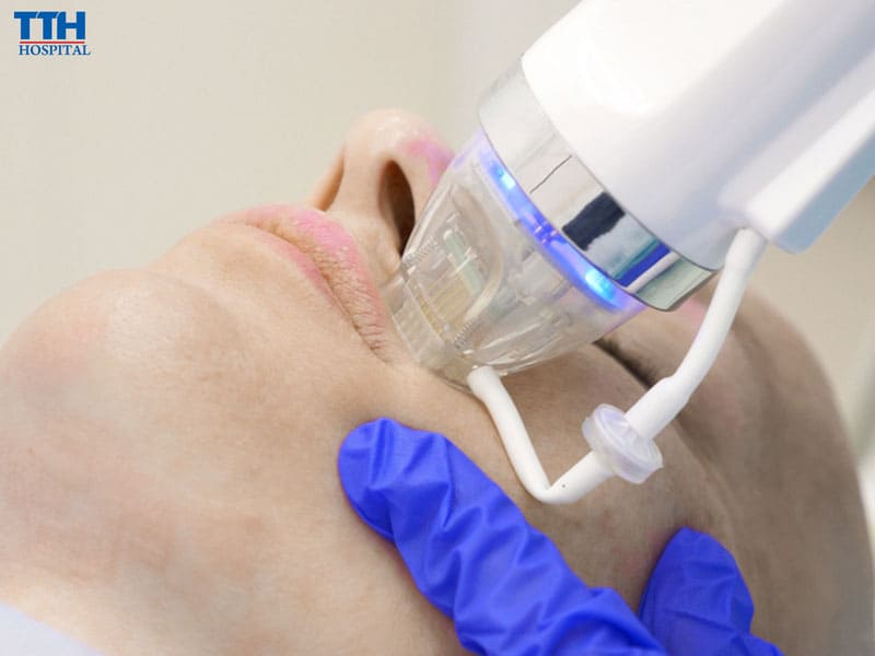 HIFU – Nâng cơ, trẻ hóa tầng sâu mà không cần phẫu thuật