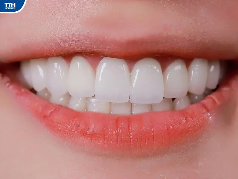 Hướng dẫn chăm sóc răng sau khi dán sứ 