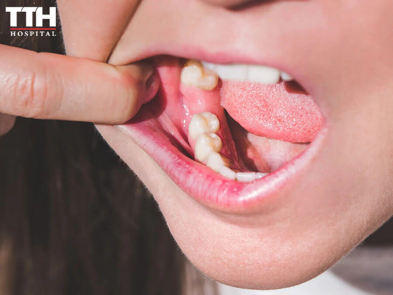 Implant CONIX phù hợp với những trường hợp nào?