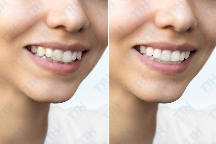 Khi nào cần lựa chọn răng sứ Orodent?