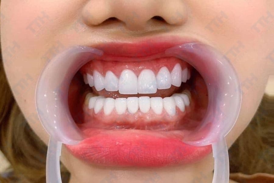 Khi nào nên lựa chọn răng sứ Orodent?