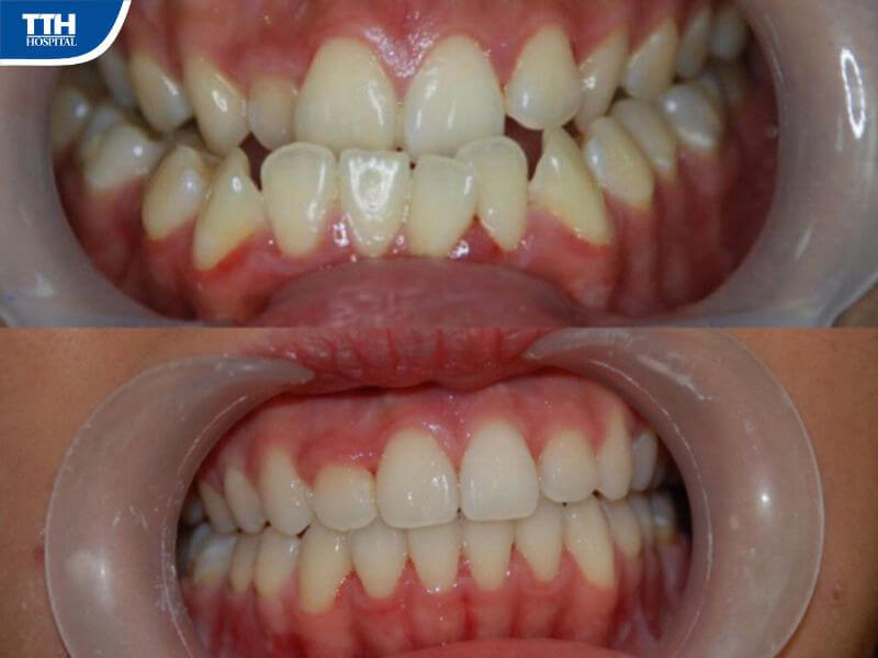 Khớp cắn ngược là gì?