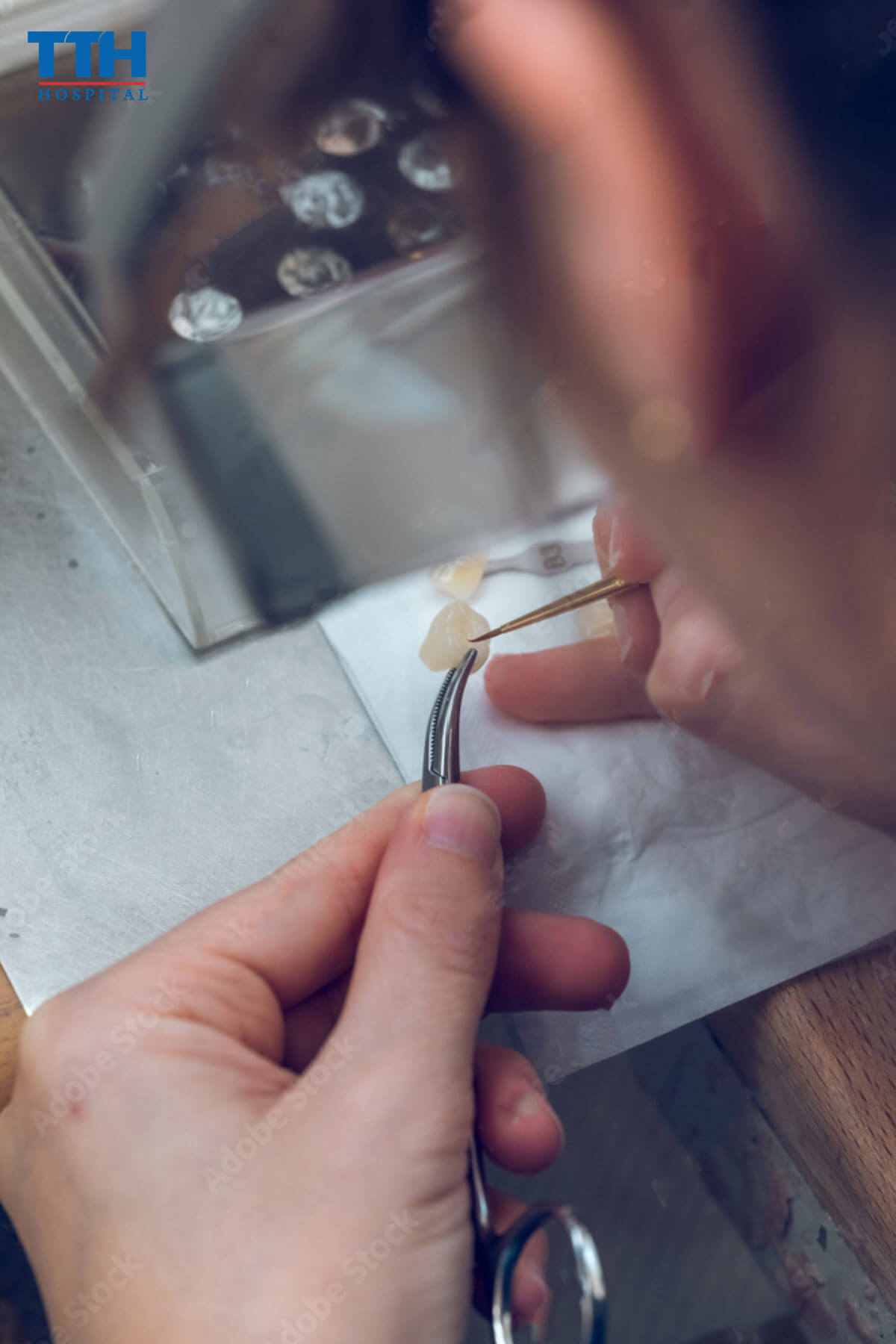 Kĩ thuật bọc răng sứ kém dẫn đến không khớp hoàn hảo khiến răng sứ ê buốt khi uống lạnh