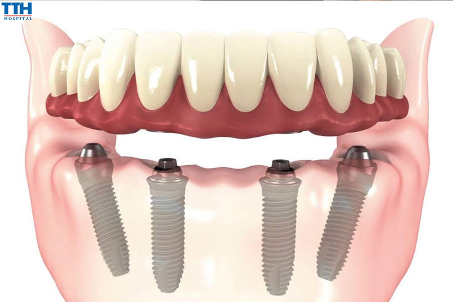 Kỹ thuật All-on-4