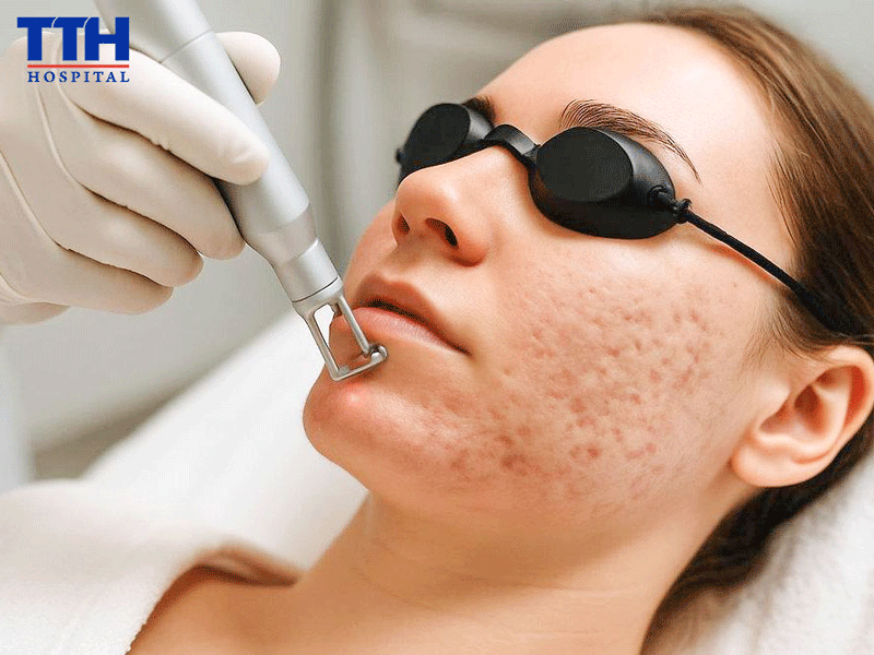 Laser CO₂ Fractional - Giải pháp hỗ trợ cải thiện sẹo rỗ an toàn, hiệu quả