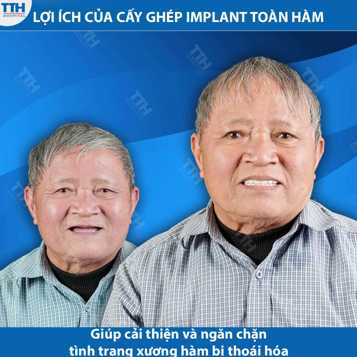 Lợi ích của cấy ghép Implant toàn hàm
