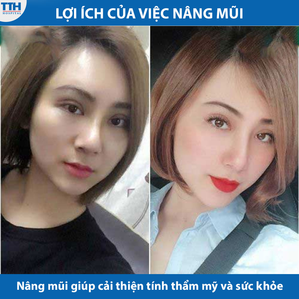 Nâng mũi giúp tăng tính thẩm mỹ và cải thiện sức khỏe