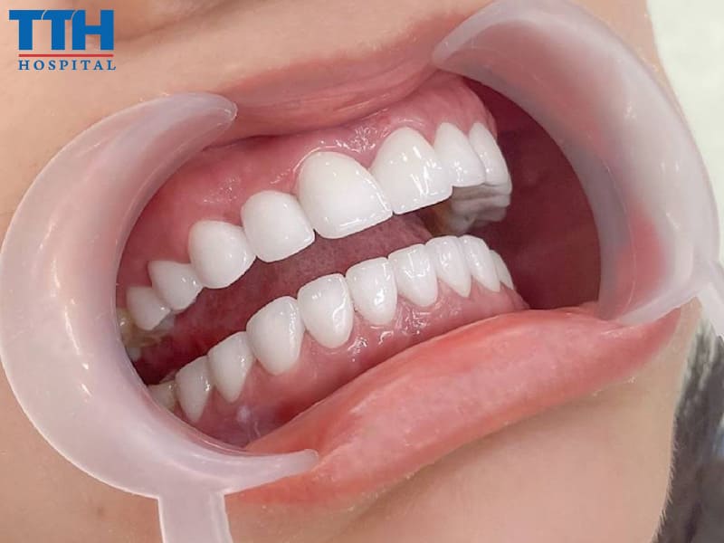 Lợi ích của răng sứ cao cấp