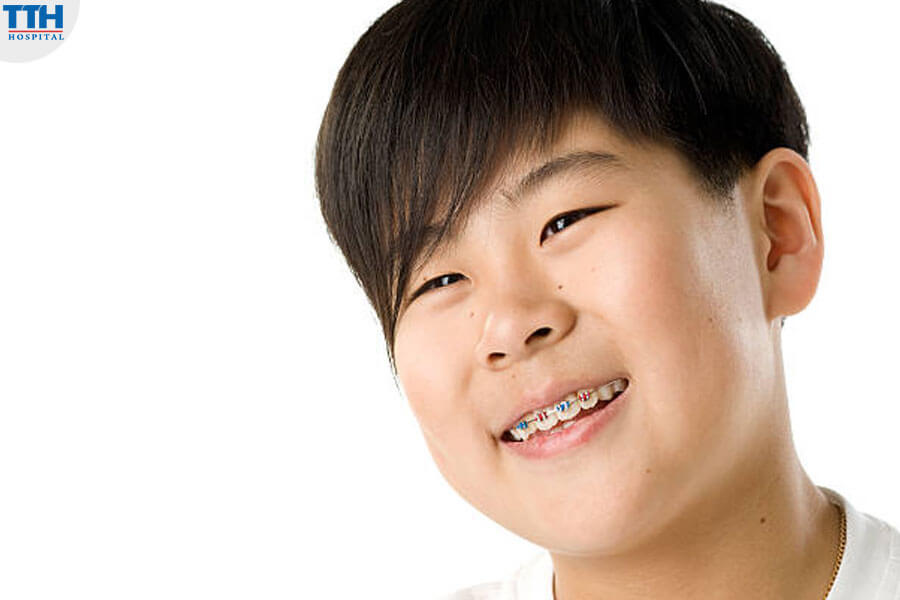 Lợi Ích Của Tiền Chỉnh Nha