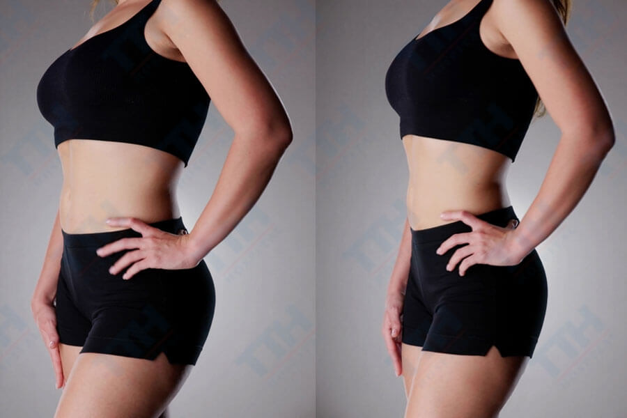 Lợi ích lâu dài của phẫu thuật tạo hình bụng bán phần