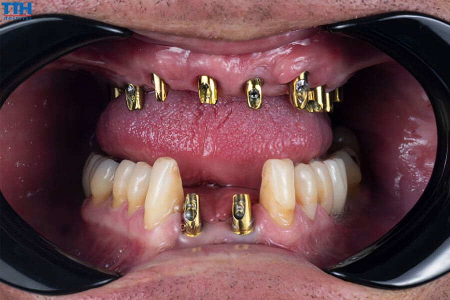 Chọn mão răng dựa trên yếu tố thẩm mỹ mà bỏ qua chức năng.