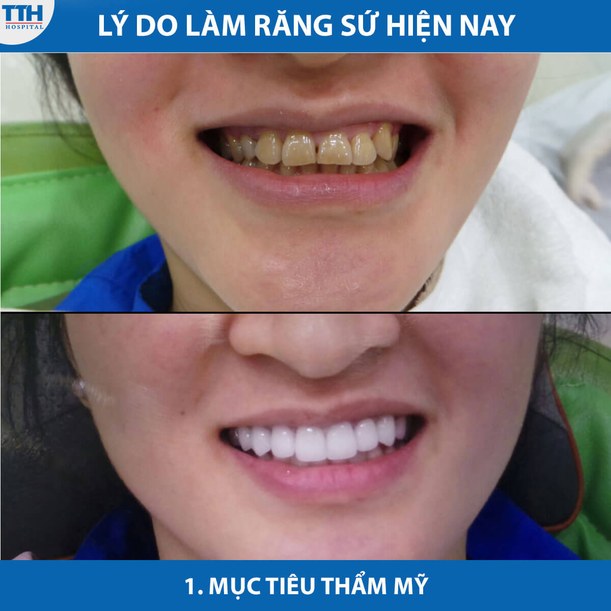 Lý do làm răng sứ hiện nay