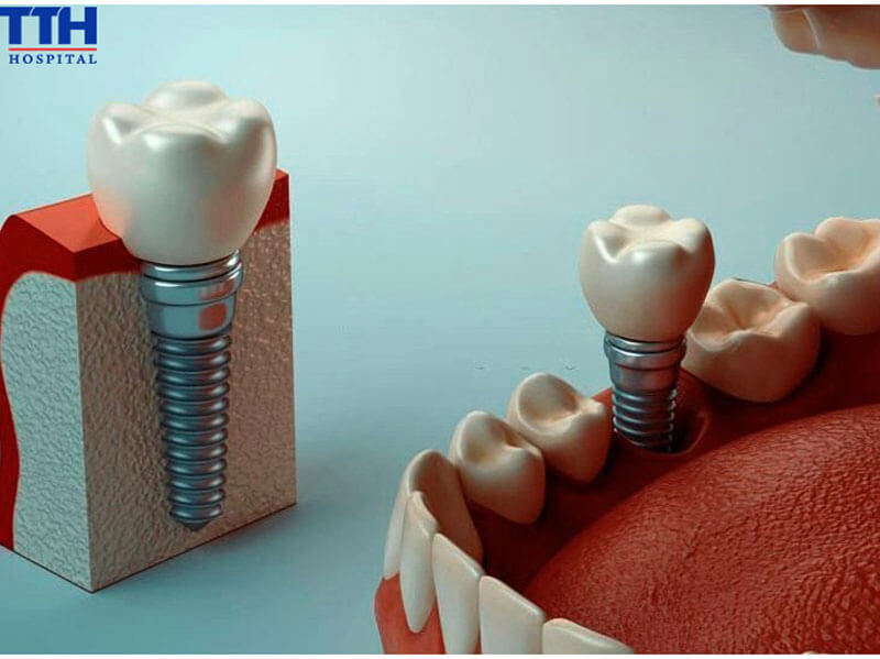 Lý Do Trồng Răng Implant Được Ưa Chuộng