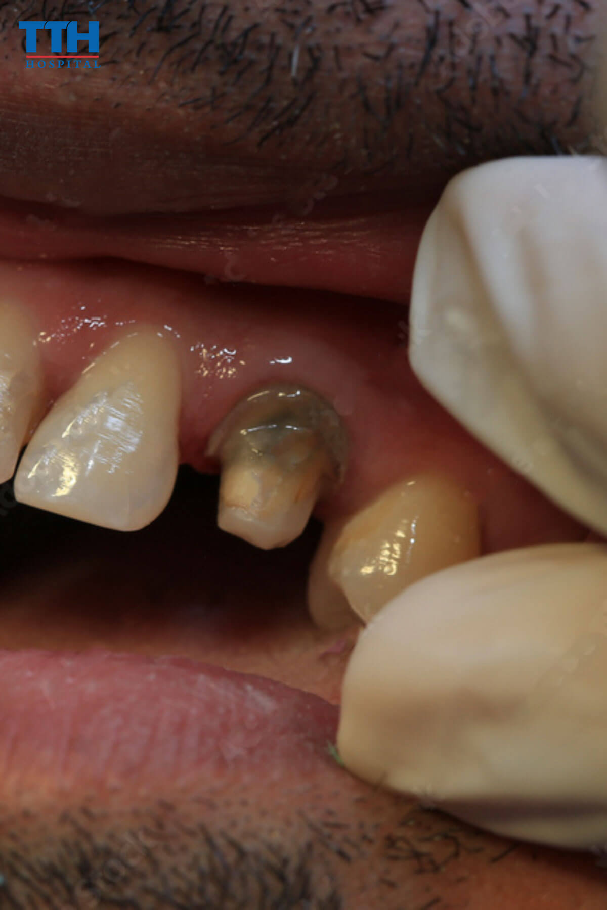 Mài răng thật quá nhiều khiến răng sứ ê buốt khi uống lạnh