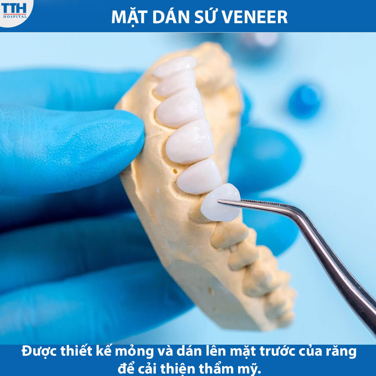 Mặt Dán Sứ Veneer