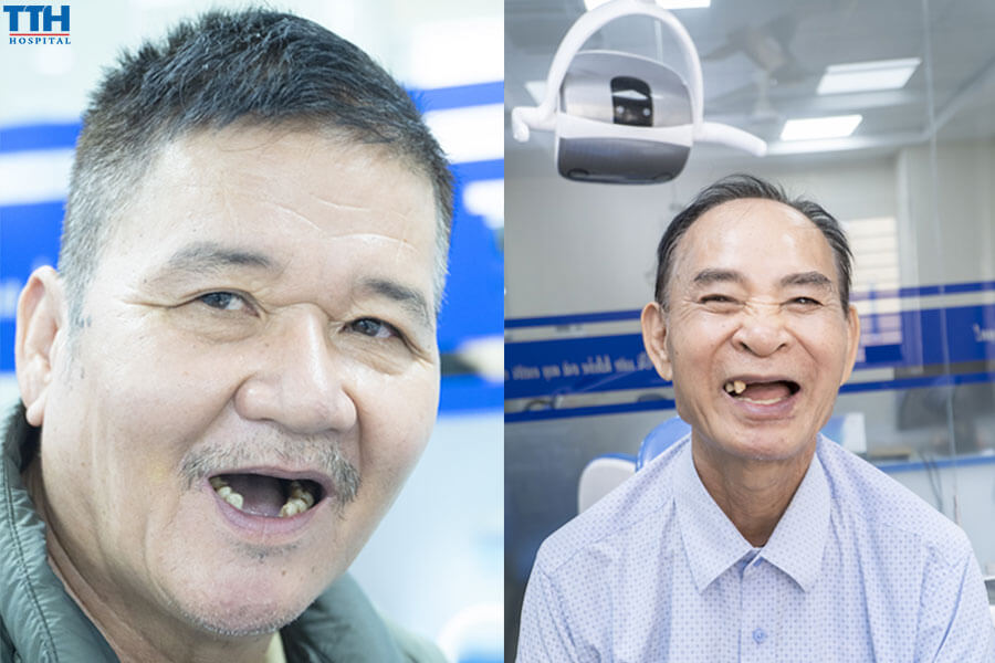 Mất răng ảnh hưởng tiêu cực đến hệ tiêu hóa như thế nào?