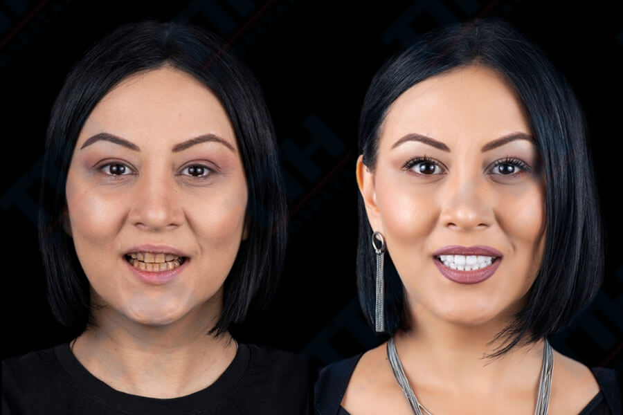 Một số lưu ý khi làm răng sứ