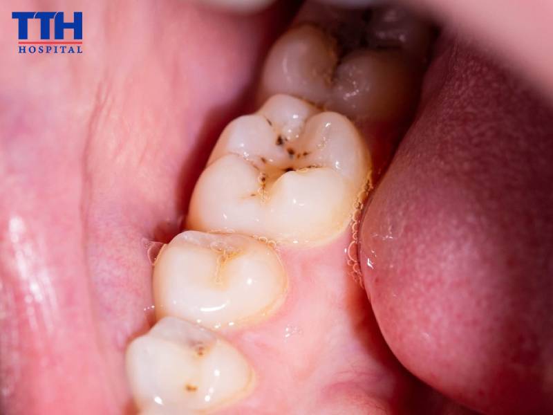 Mức độ 2 - Sâu ngà nông