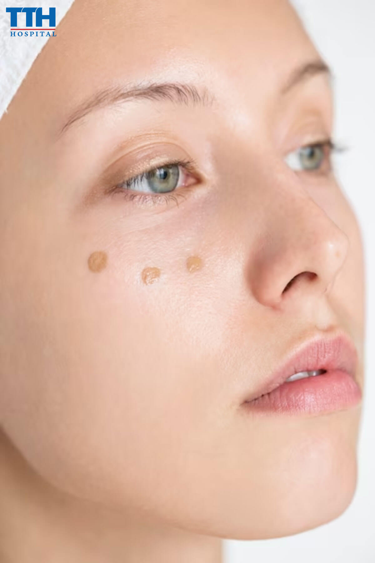 Nám Hori là gì trị nám tại Vinh, Nghệ An