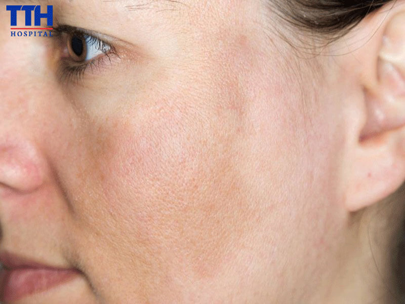 Nám sạm da là gì?