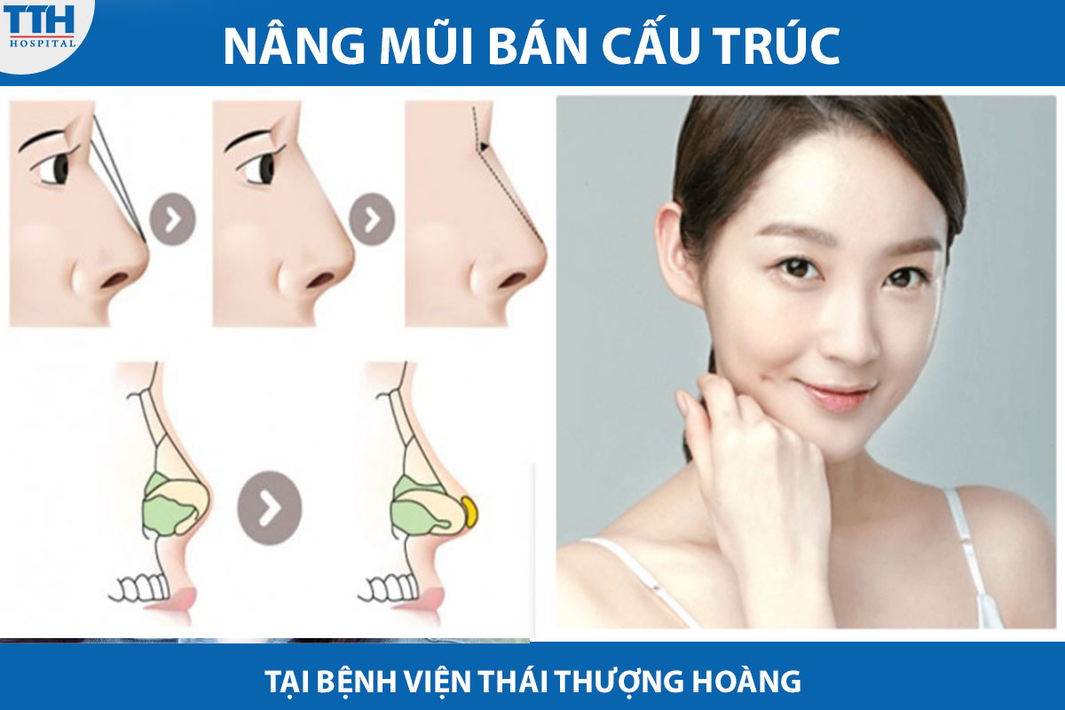 Nâng mũi bán cấu trúc tạo ra sự cân đối và hài hòa bằng cách thay đổi các yếu tố