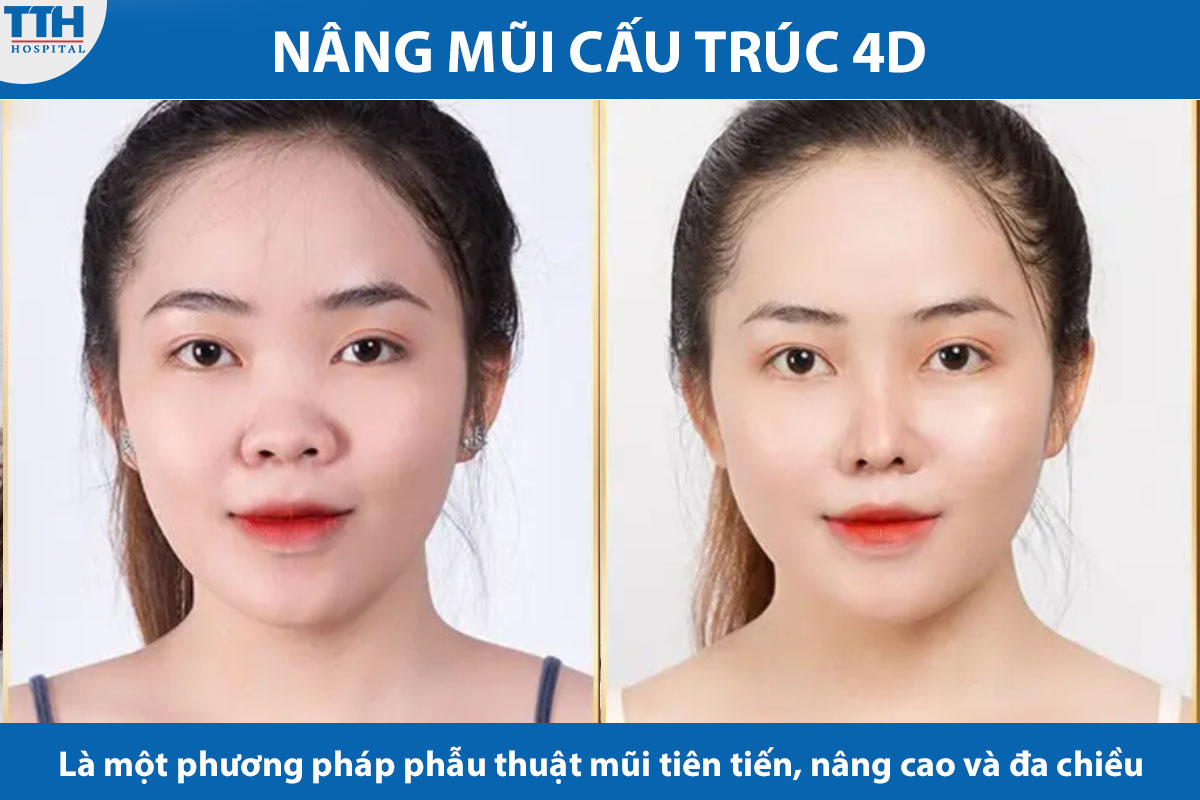 Nâng mũi cấu trúc là  một phương pháp phẫu thuật mũi tiên tiến, nâng cao và đa chiều