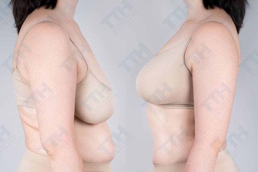 Nâng ngực chảy xệ: Tổng quan về hai phương pháp chính
