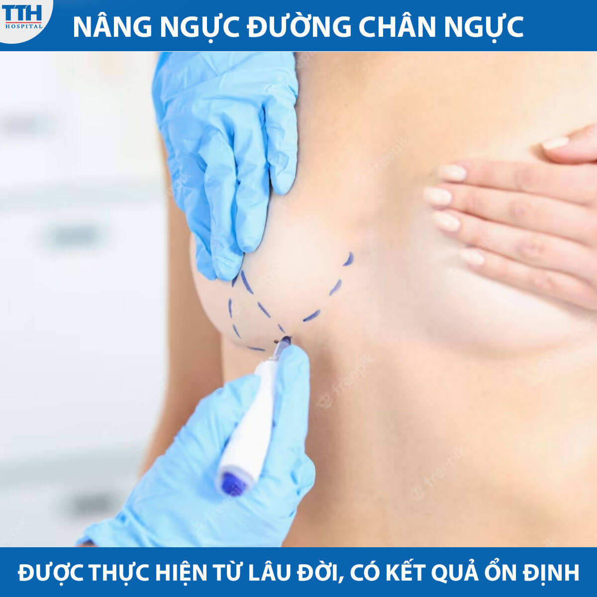 Nâng ngực đường chân ngực là phương pháp nâng ngực thông thường và  đã được thực hiện từ lâu.