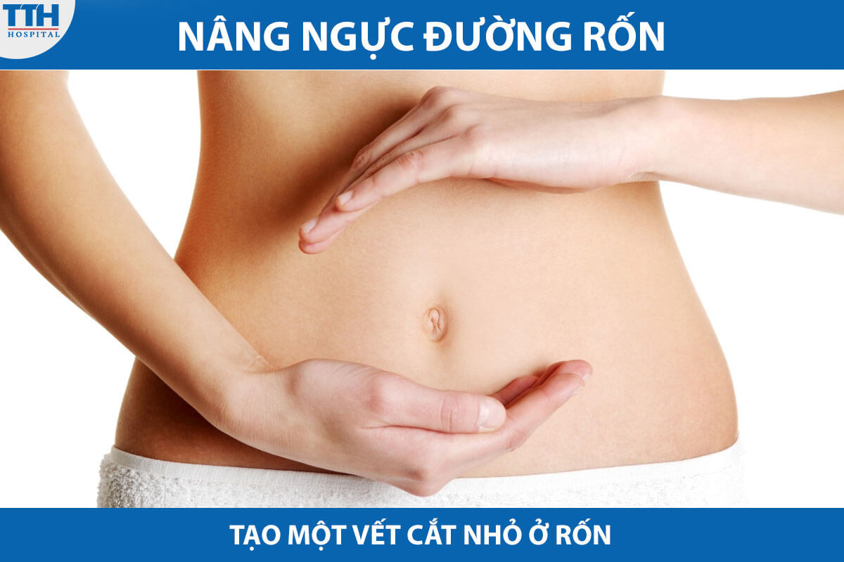 Nâng ngực qua rốn giúp giảm thiểu sẹo và cho phép tấm implant được đặt một cách chính xác và tự nhiên.