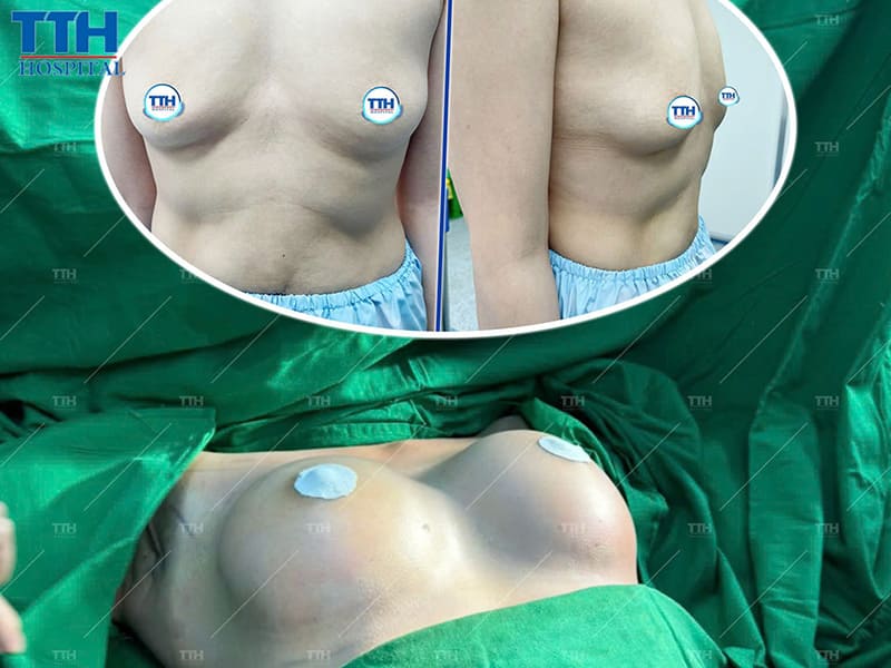 Nâng ngực ở đâu an toàn và uy tín?