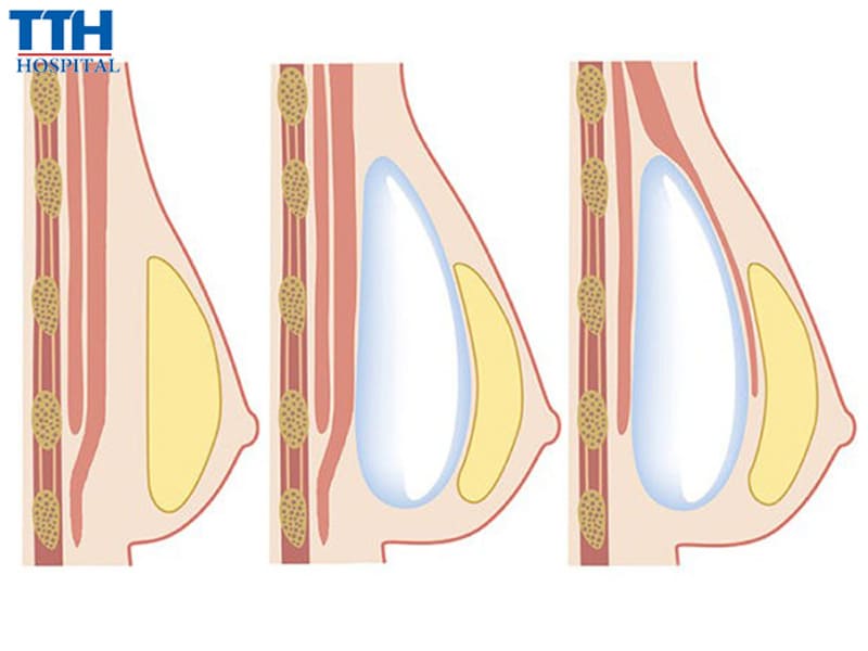 Nâng ngực sau sinh có ảnh hưởng đến việc sinh con và cho con bú sau này?
