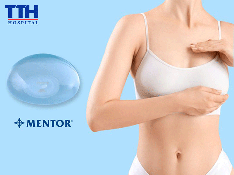 Nâng ngực túi Mentor - Xu hướng làm đẹp được nhiều chị em ưa chuộng