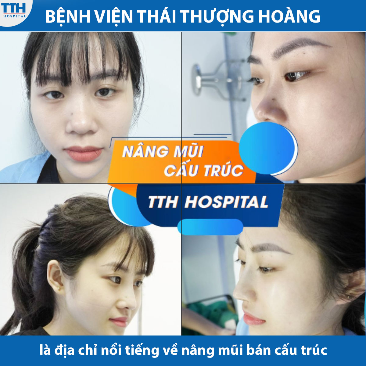 Bệnh viện Thái Thượng Hoàng là một trong những địa chỉ nổi tiếng về nâng mũi bán cấu trúc.