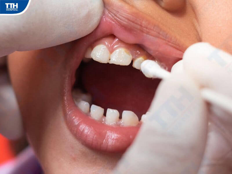 Nếu bé nuốt Vecni Fluor thì có nguy hiểm không?