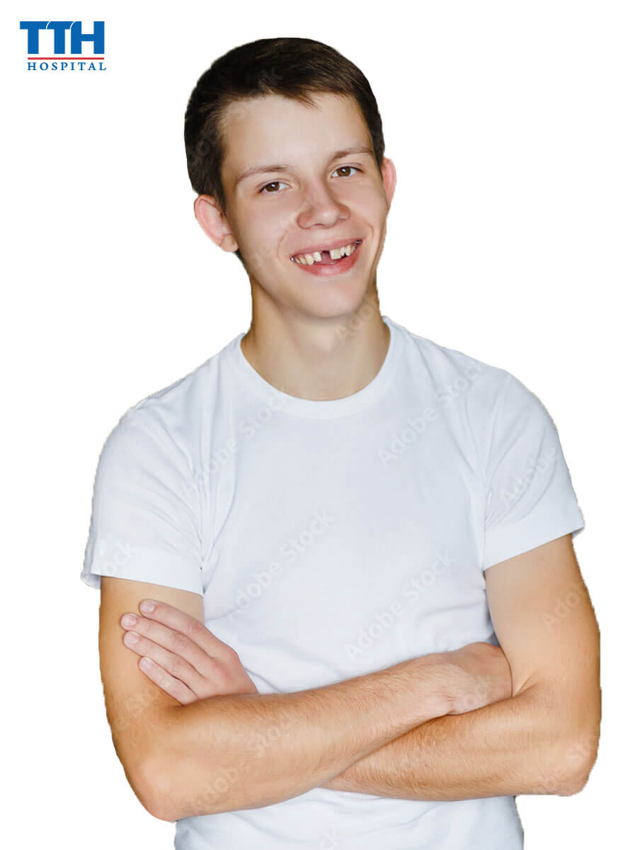 Nguyên nhân gây ra tình trạng răng thưa