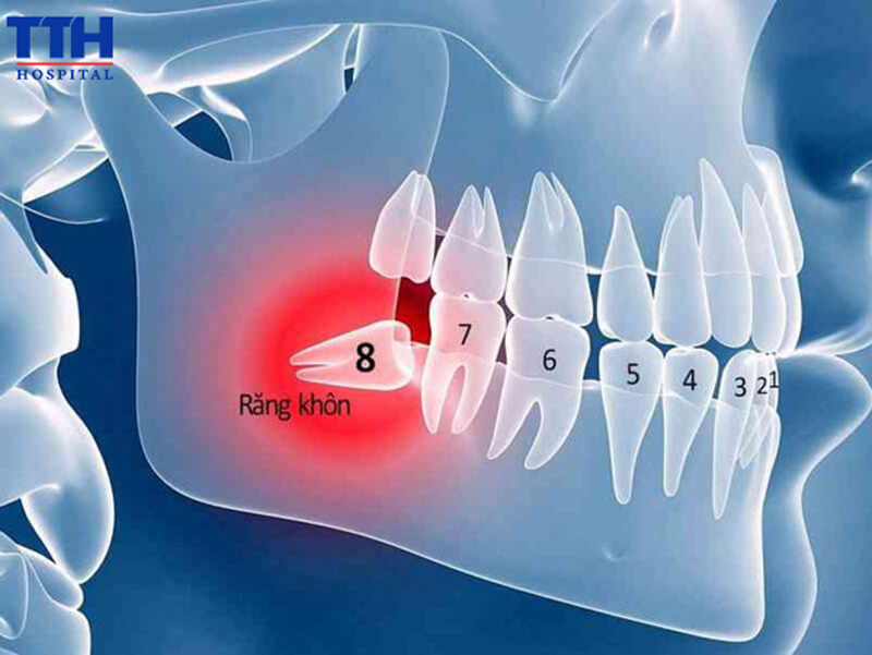 Nguyên nhân khiến răng khôn mọc lệch?