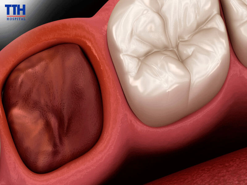 Nguyên nhân khiến vết nhổ răng khôn bị chảy máu