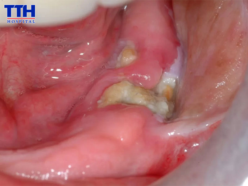 Vì sao nhổ răng có nguy cơ nhiễm trùng?