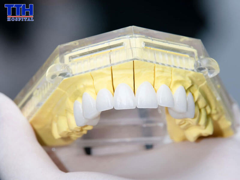 Những ai nên làm răng sứ thẩm mỹ?