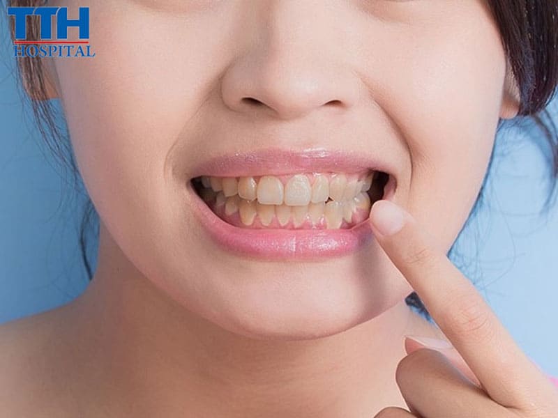 Những ai nên lựa chọn răng sứ Lava?