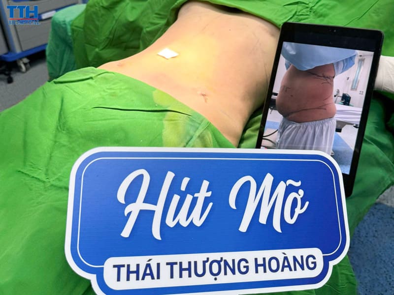Những ai nên và không nên hút mỡ toàn thân
