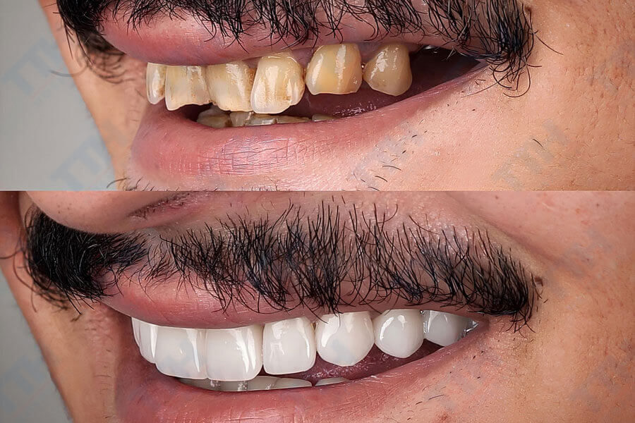 Những Ai Phù Hợp Với Răng Sứ Veneer Lisi?