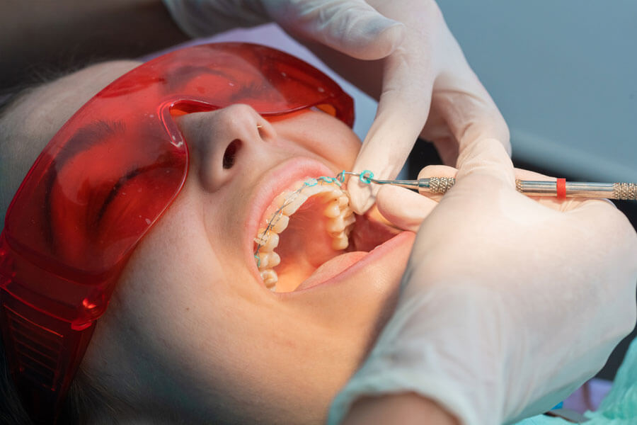 Những cảm giác có thể xuất hiện sau khi tháo niềng