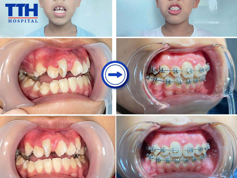 Những dấu hiệu cảnh báo trẻ cần được khám chỉnh nha