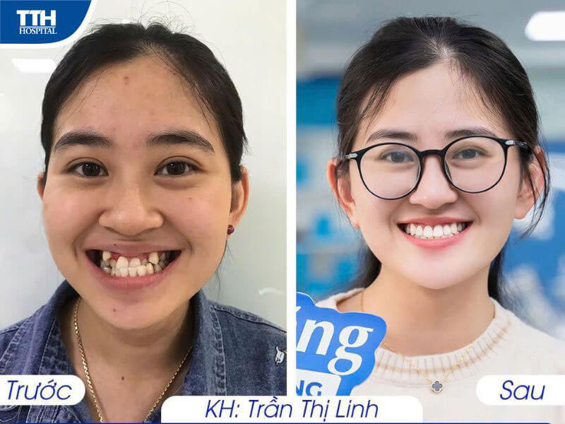 Những điều bạn cần biết trước khi bắt đầu hành trình chỉnh nha